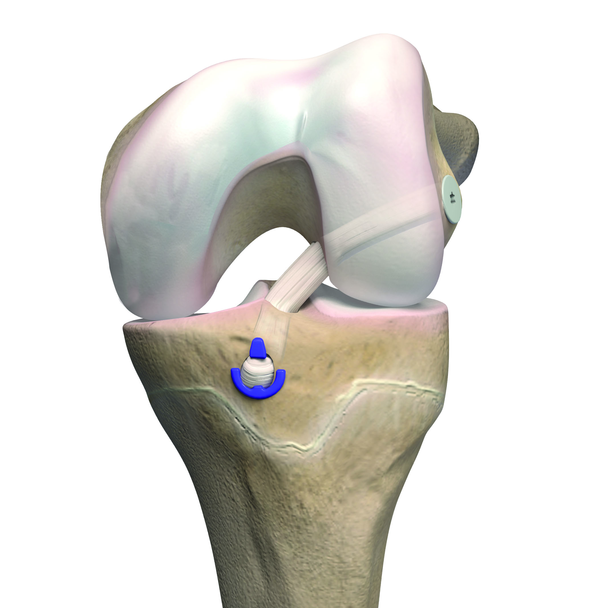 Операция колено пкс. ПКС (передняя крестообразная связка). Anterior cruciate ligament Reconstruction. St аутопластика ПКС коленного сустава. ПКС задняя крестообразная.