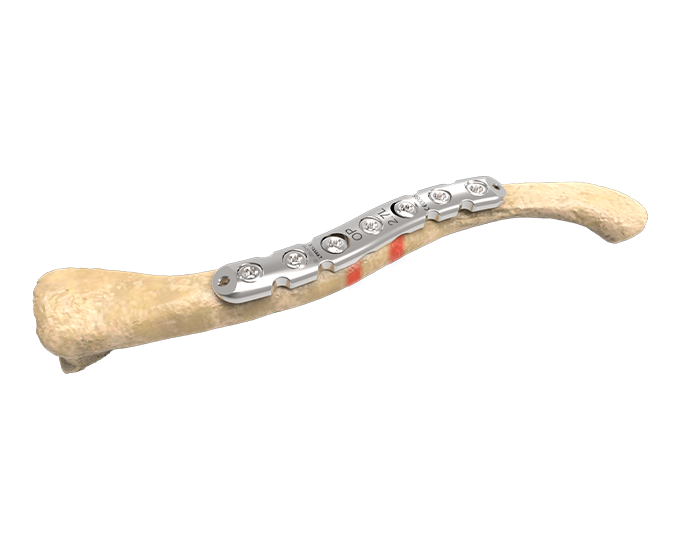 PediFrag – Clavicle Skeleton