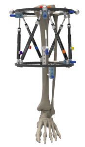 Orthex Frame Skeleton Example