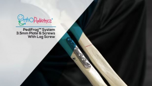 PediFrag System