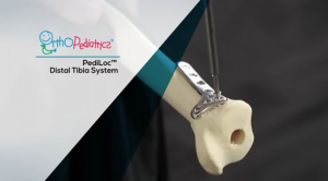 Distal Tibia System