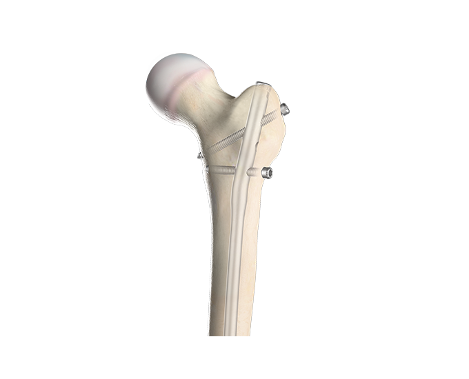 Pediatric Nailing Platform | Femur