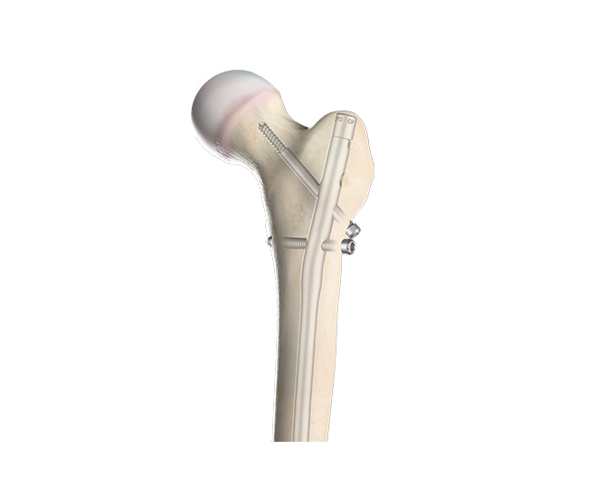 Pediatric Nailing Platform | Femur