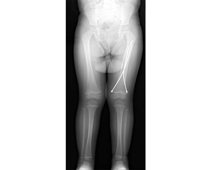 PediFlex X-ray