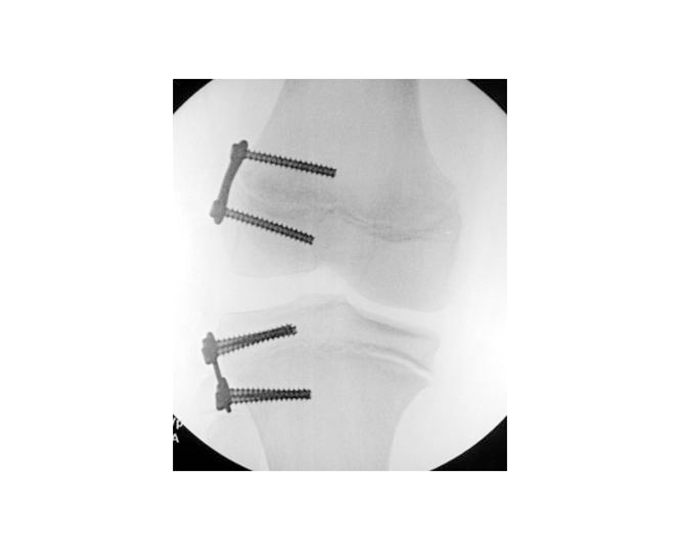 PediPlates X-Ray