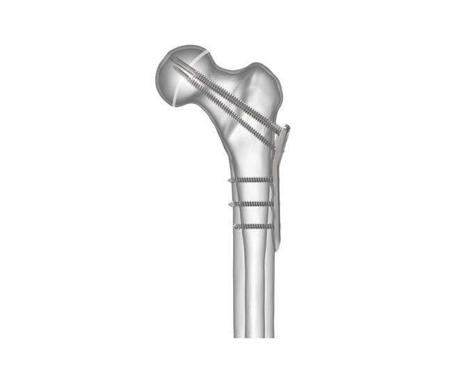 Transphyseal Screws Side View