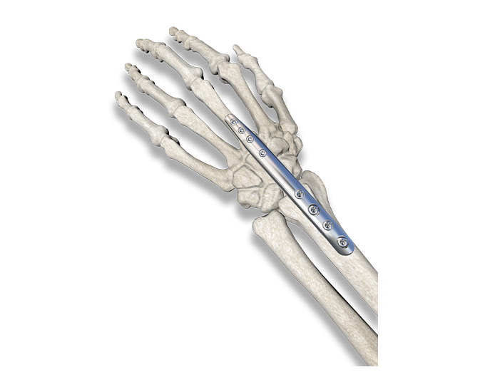 PediFrag – Wrist Fusion Skeleton