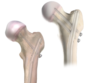 Rigid Nail implant in the bone