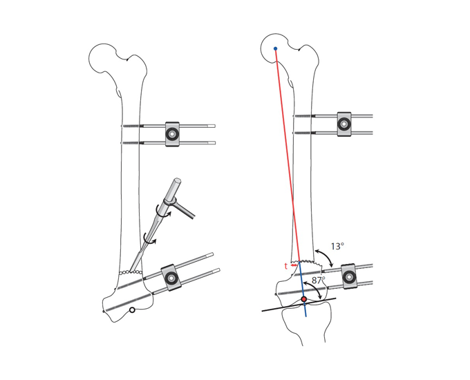Diagram showing the use of DPOS in an osteotomy procedure