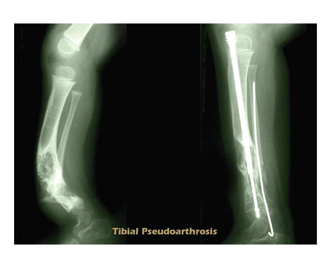 X-ray showing Fassier-Duval Telescopic system in a child