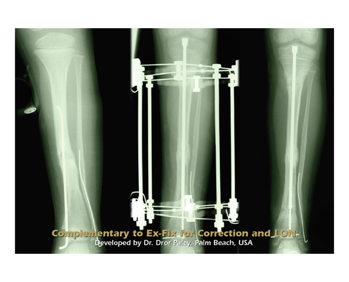 Fassier-Duval - Intra-Medullary OrthoPediatrics System® Telescopic