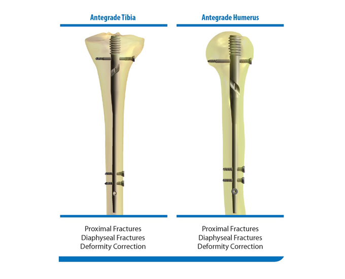 diagram showing use of the GAP nail system in an antegrade and retrograde femur