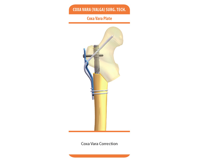 diagram showing the GAP nail with a Coxa Vara plate