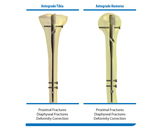 Diagram showing the GAP Nail system in an antegrade tibia and an antegrade humerus