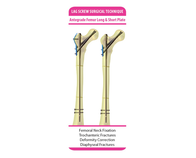 Diagram of GAP nails with long and short plates to correct antegrade femurs