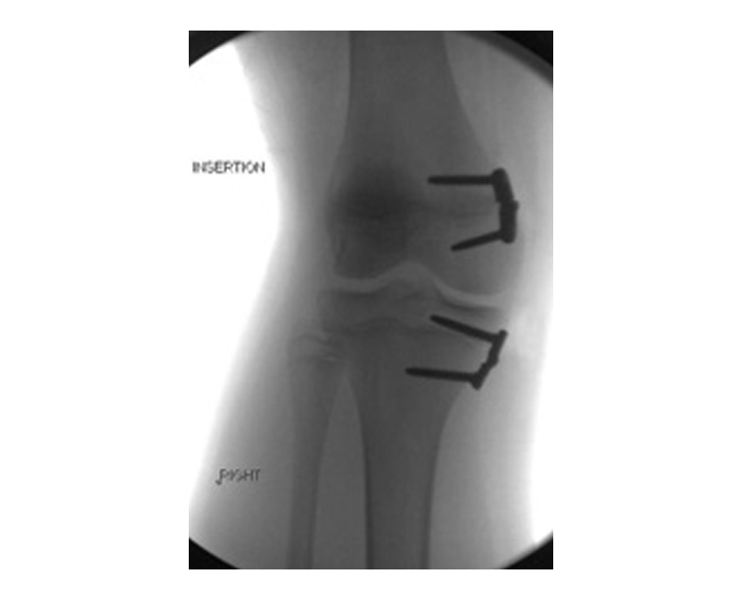 x-ray of a patient's knee with two hinge plates inside