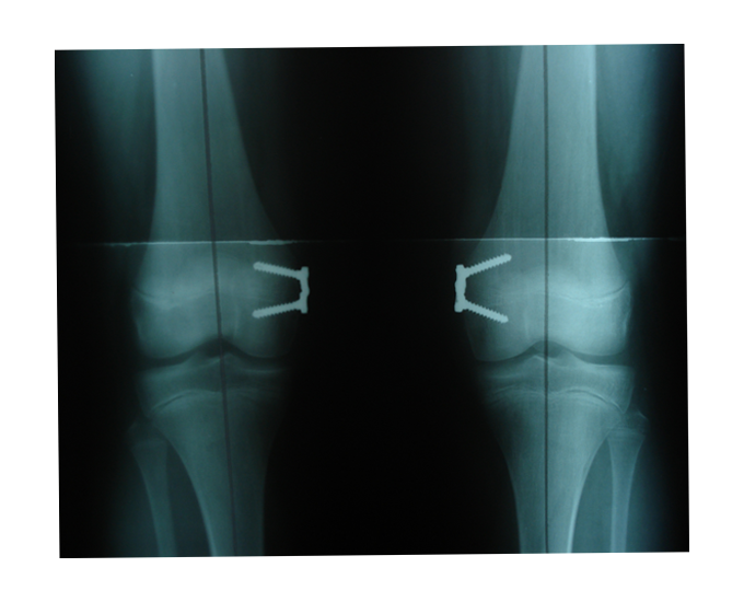 X-ray showing the hinge plating system in a child's knees