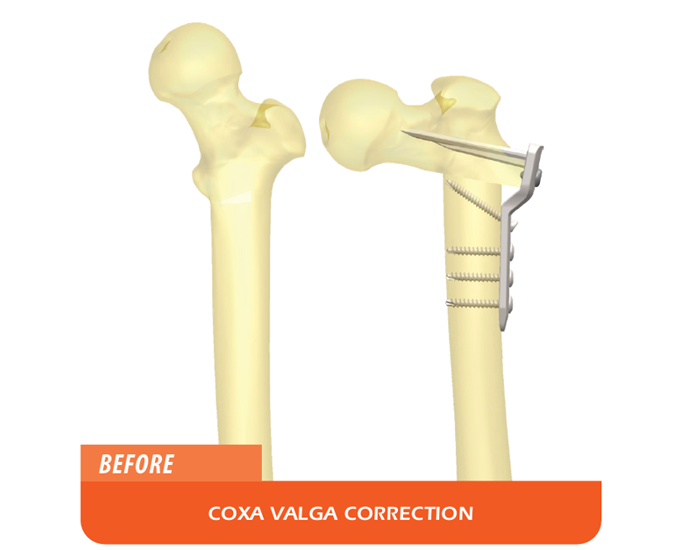 diagram of a cox valga correction using the LolliPOP system before and after the procedure
