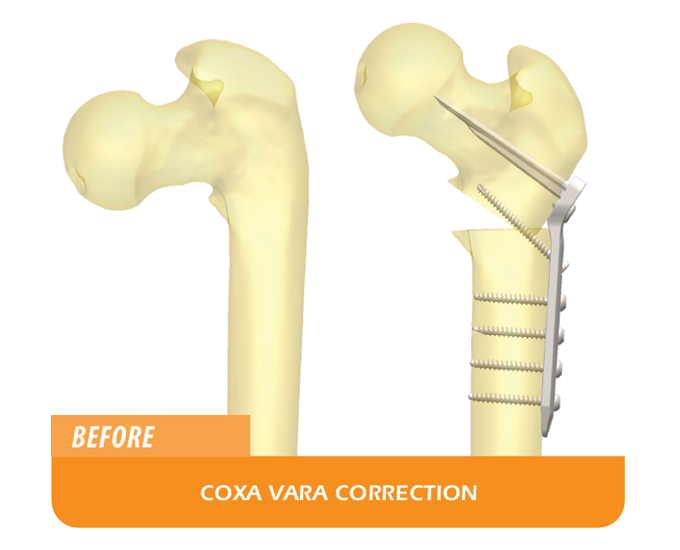 diagram of a cox vara correction using the LolliPOP system before and after the procedure