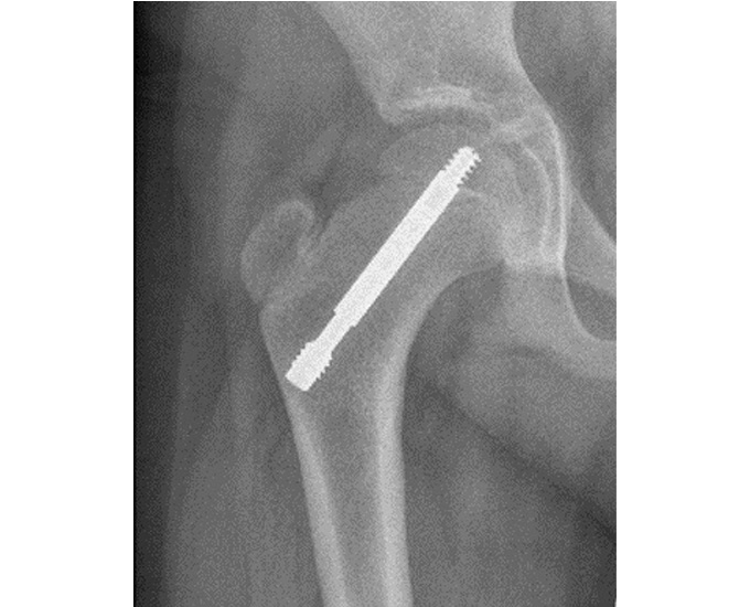 x-ray showing the SCFE screw in the body