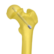 Diagram of the screw system in a femur bone