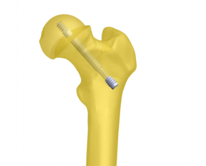 Diagram of the screw system in a femur bone