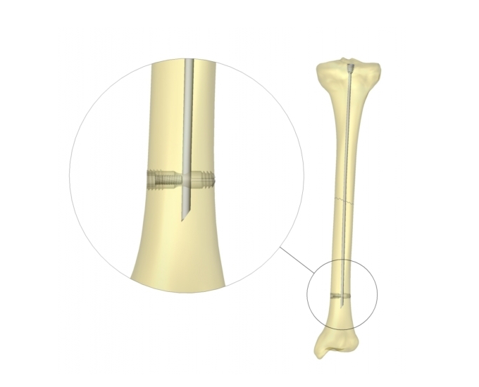 diagram showing the SLIM system in a bone. The bottom part of the implant in the bone is enlarged for viewing purposes.