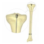 diagram showing the SLIM system in a bone. The top part of the implant in the bone is enlarged for viewing purposes.