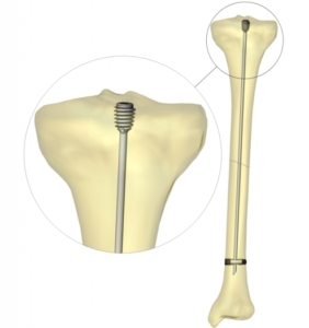 SLIM™ - Système Intramédullaire de Verrouillage Simple