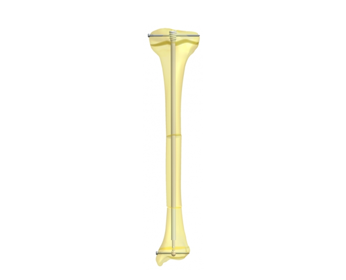 Diagram of Tibia bone with Fassier-Duval nail and pegs