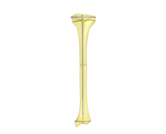 Fassier-Duval Telescopic Intra-Medullary System® - OrthoPediatrics