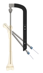 A 3D Rendering of the GAP Nail.