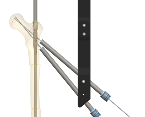 A 3D Rendering of the GAP™ Nail.