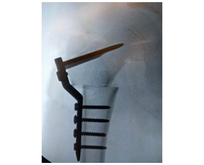 X-ray of the LolliPOP system attached to the bone after an osteotomy was made