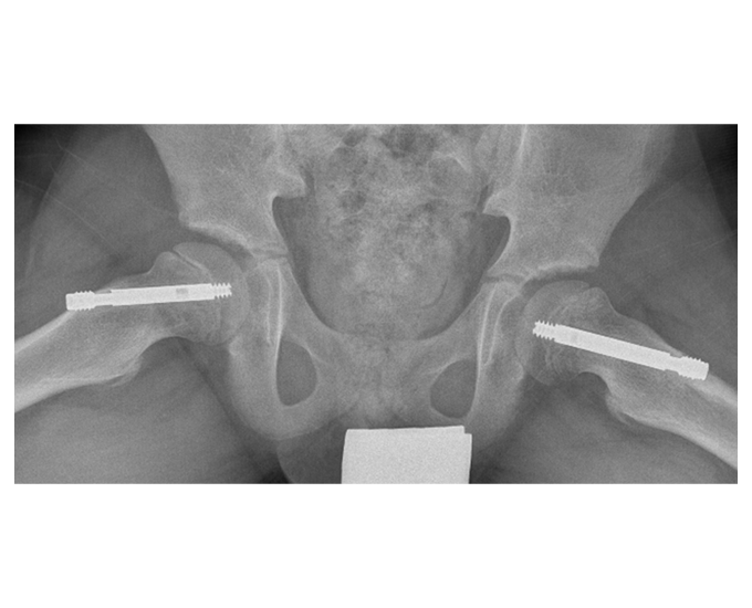 X-Ray showing the Free Gliding SCFE Screw System in the body.