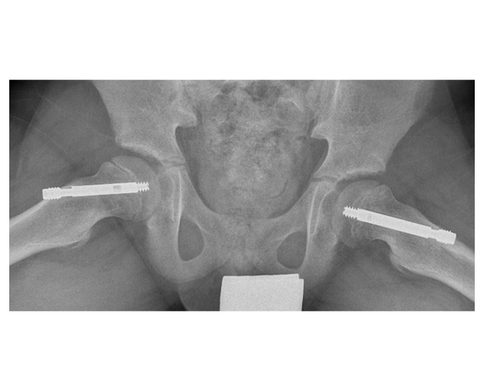 X-Ray showing the Free Gliding SCFE System  