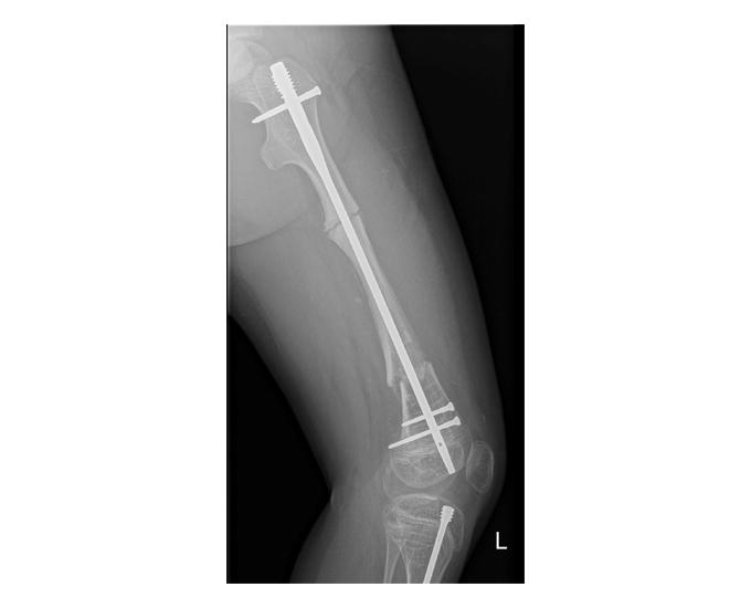 X-Ray showing the GAP system in the body