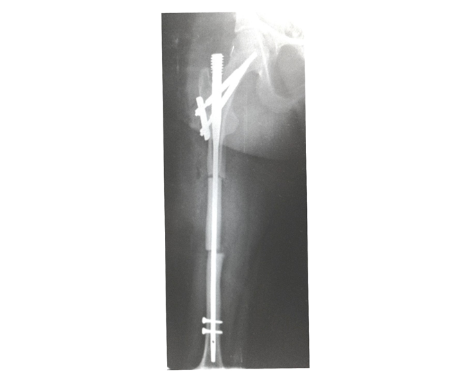 X-Ray showing GAP in the body