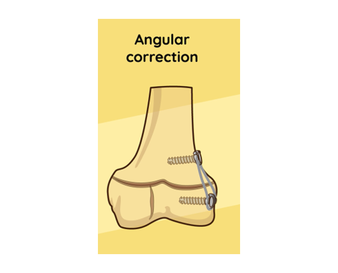 A drawing of the Giro angular correction.