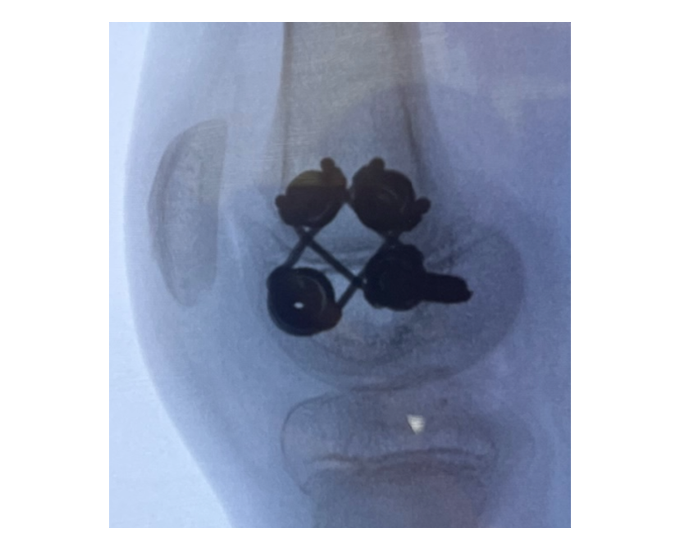 X-ray showing the Giro system inside the bone.