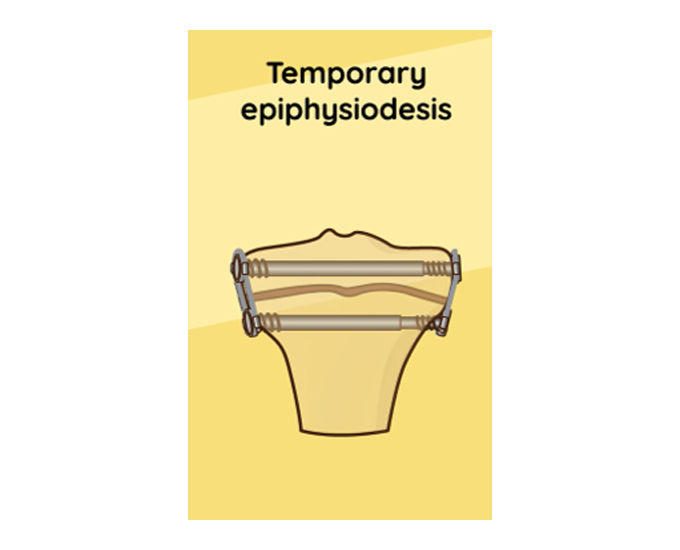 A drawing of the Giro temporary epiphysiodesis.
