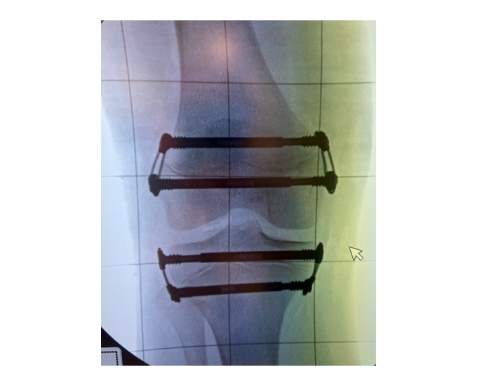 X-ray showing the temporary epiphysiodesis.