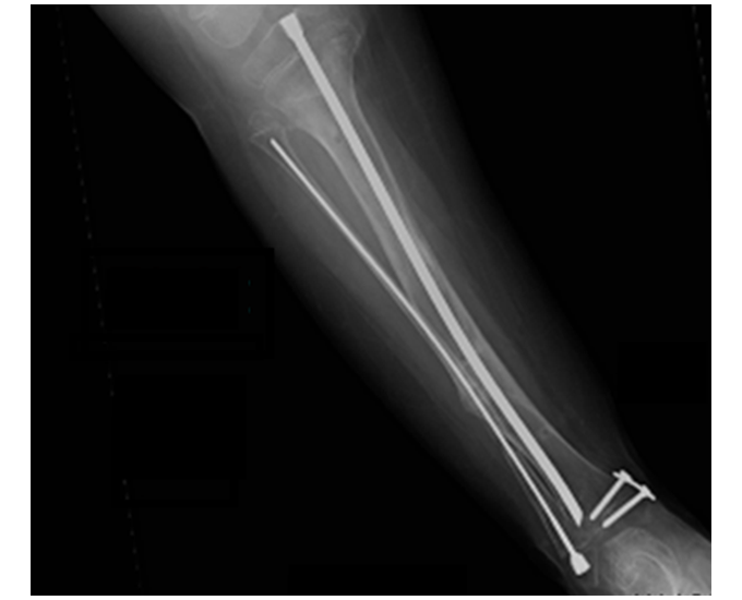 X-Ray showing SLIM in the body
