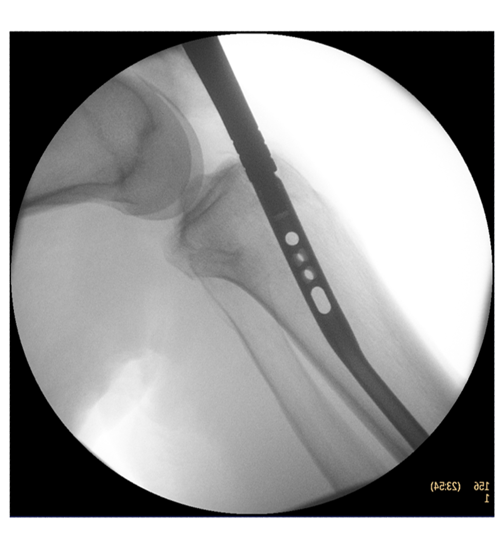 PNP Tibia x ray