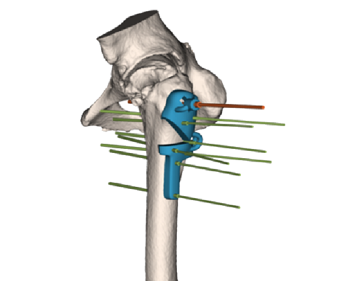 Image of a 3D Side model in the bone.