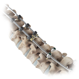 VerteGlide™ System on a model of a spine.