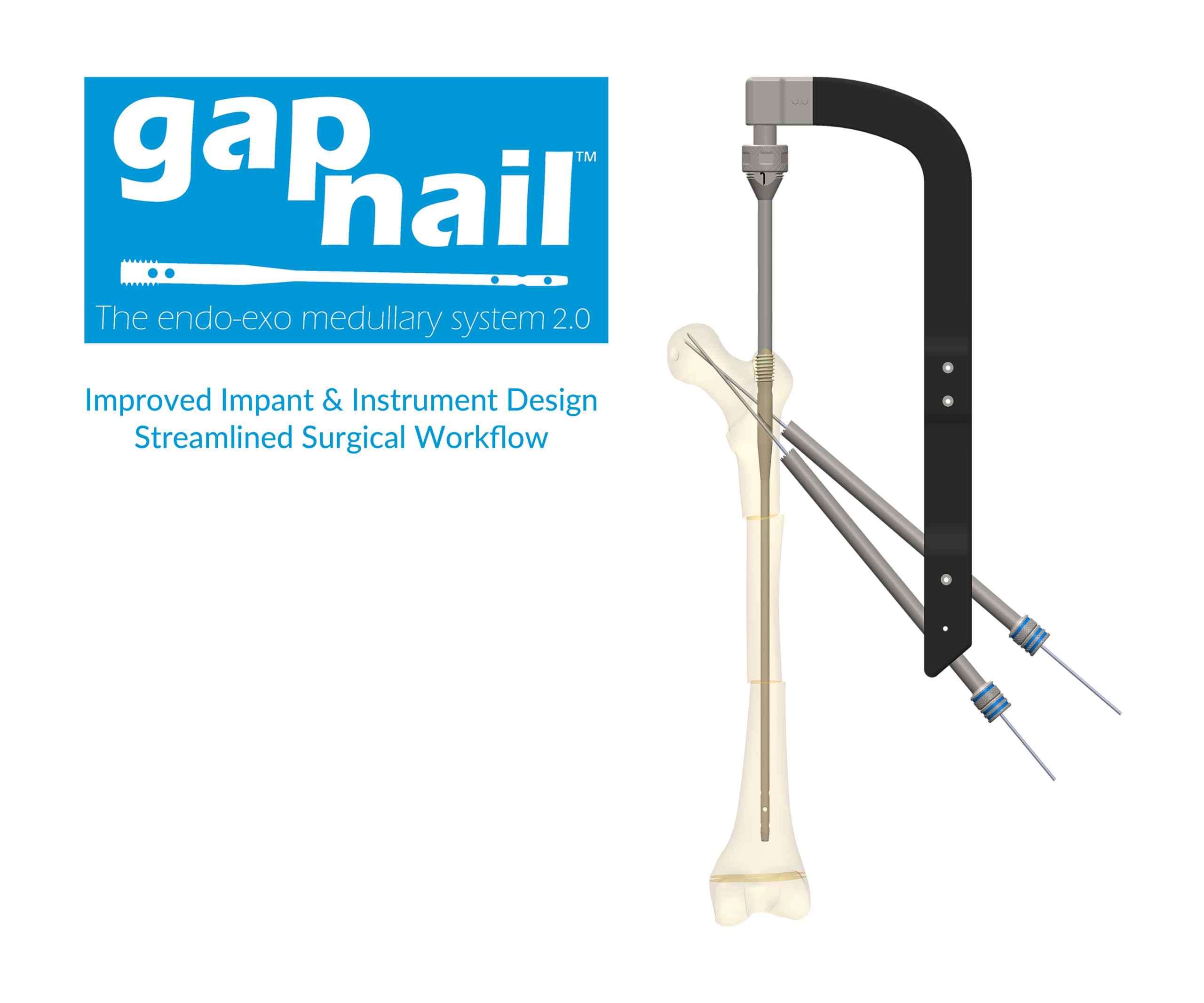 A 3D Rendering of the GAP™ Endo-Exo Medullary Nail.