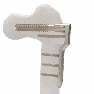 Pediatric Plating Platform™ | Hip (Deformity)