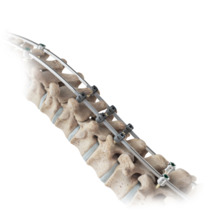 Verteglide™ System on a model of a spine.