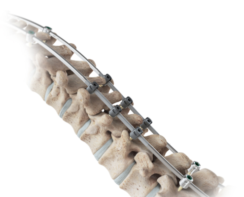 VerteGlide™ System on a model of a spine.